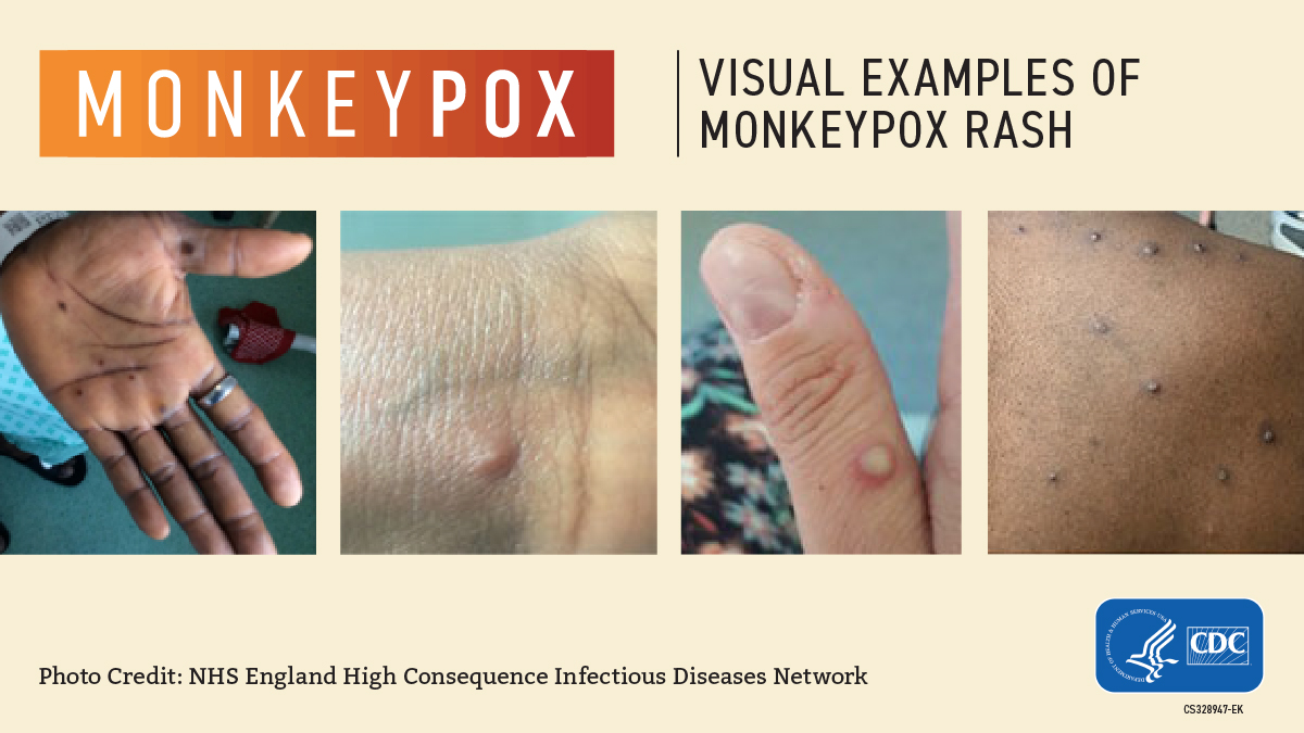 Monkeypox Information and Resources