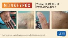photographs of monkeypox symptoms