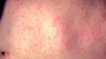 Measles rash with red bumps