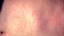 Measles rash with red bumps